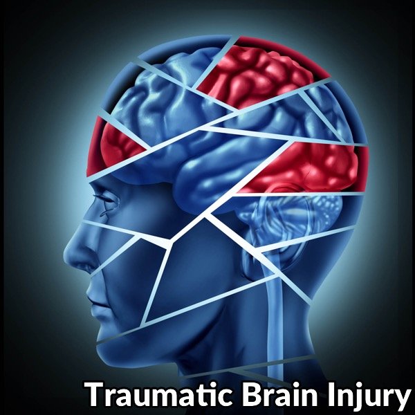 abogados de lesiones cerebrales en Florida